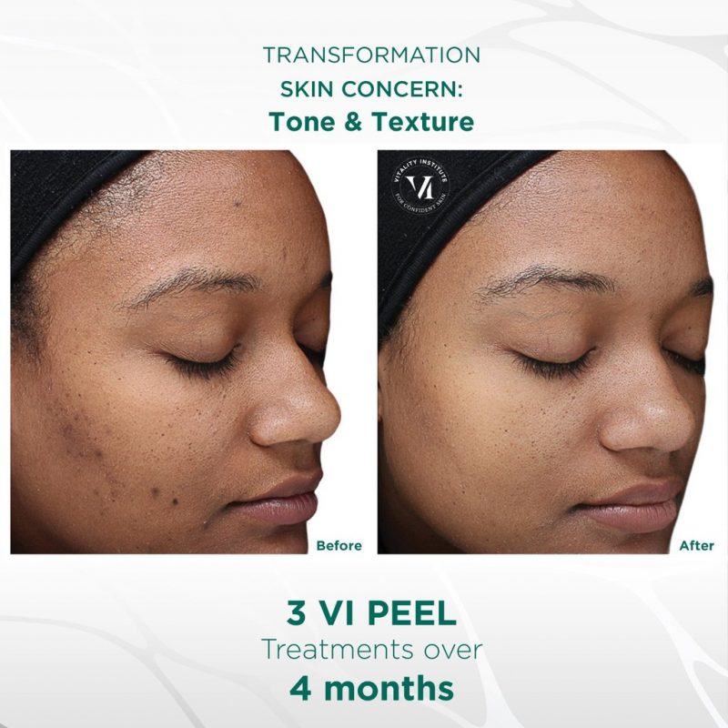 Chemical Peel Nyc Vi Peel Tca Cross Pq Age Peel V Carbon 4143