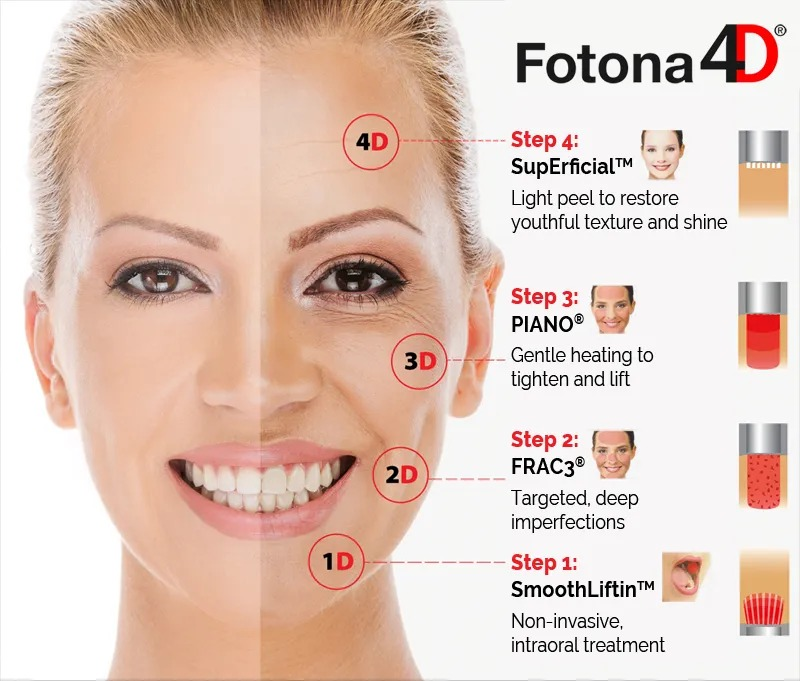 4 Stages of Fotona 4D - Non-Invasive Facelift and Skin Tightening Treatment NYC