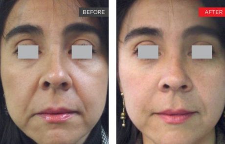 Fotona 4D Non-Invasive Facelift - Before and After 1 - Manhattan, NYC
