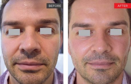 Fotona 4D Non-Invasive Facelift Manhattan, NYC - Before and After 2