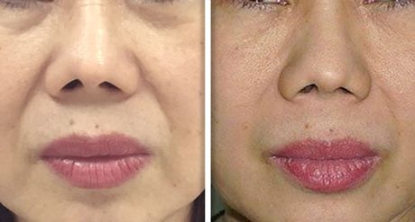 Fotona 4D Non-Invasive Facelift Manhattan, NYC - Before and After 4