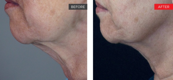 Fotona 4D Non-Invasive Neck Lifting - Before and After 1