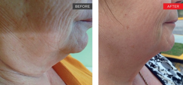 Fotona 4D Non-Invasive Neck Lifting - Before and After 2
