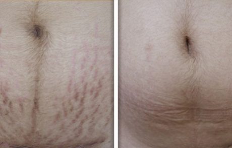 Fotona 4D Stretch Mark Revisions Non-Invasive Laser Treatment NYC - Before and After 1