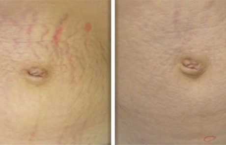 Fotona 4D Stretch Mark Revisions Non-Invasive Laser Treatment NYC - Before and After 2