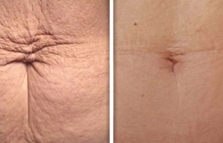 Fotona 4D Stretch Mark Revisions Non-Invasive Laser Treatment NYC - Before and After 3
