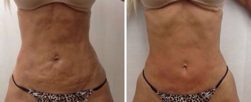 Fotona 4D Stretch Mark Revisions Non-Invasive Laser Treatment NYC - Before and After 5