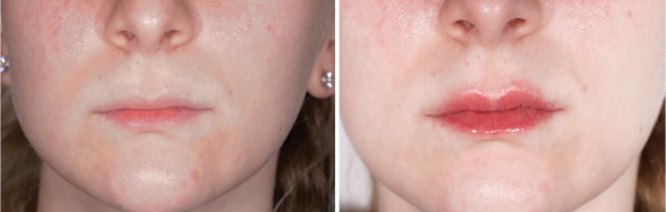 Fotona Liplase™ Lip Plumping Treatment NYC - Before and After 3 (1)