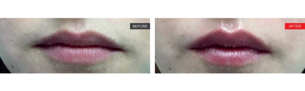 Fotona Liplase™ Lip Plumping Treatment NYC - Before and After 3 (2)