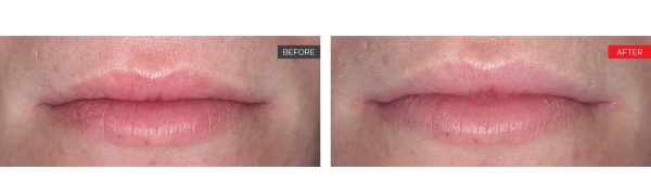 Fotona Liplase™ Lip Plumping Treatment NYC - Before and After 3 (3)