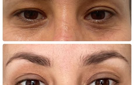 Fotona SmoothEye® Treatment NYC - Before and After (5)
