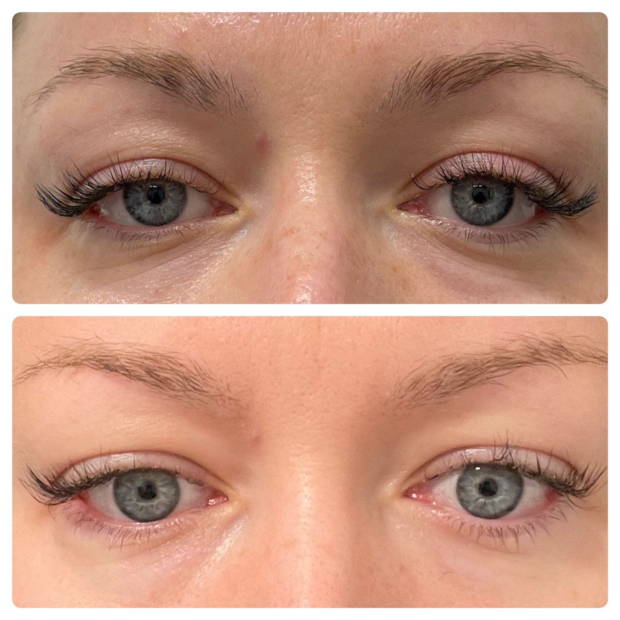 Fotona SmoothEye® Treatment NYC - Before and After (7)