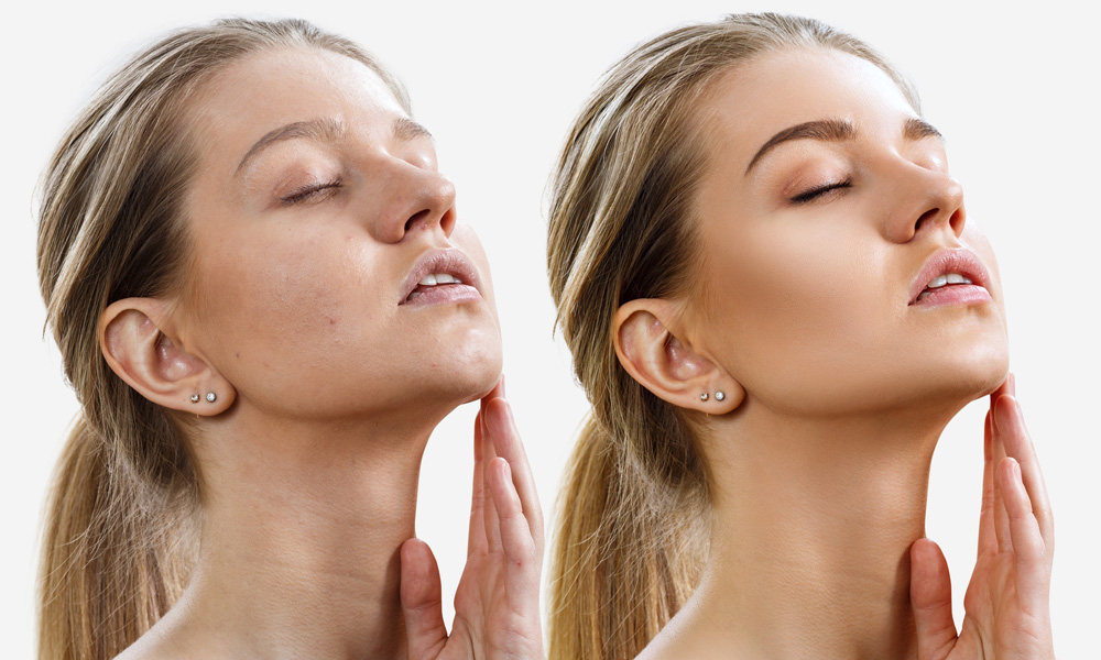 Microneedling with Exosome Therapy NYC - Facial and Skincare Manhattan