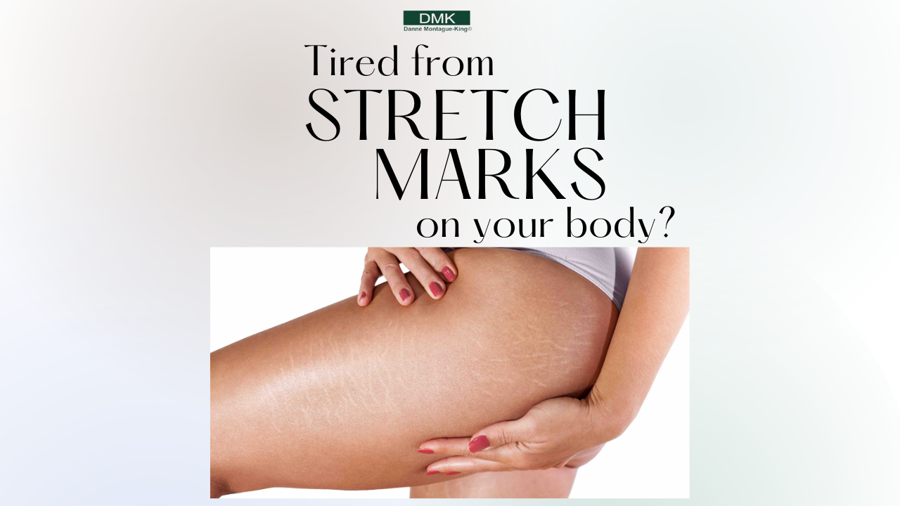 Leg with Stretch Marks