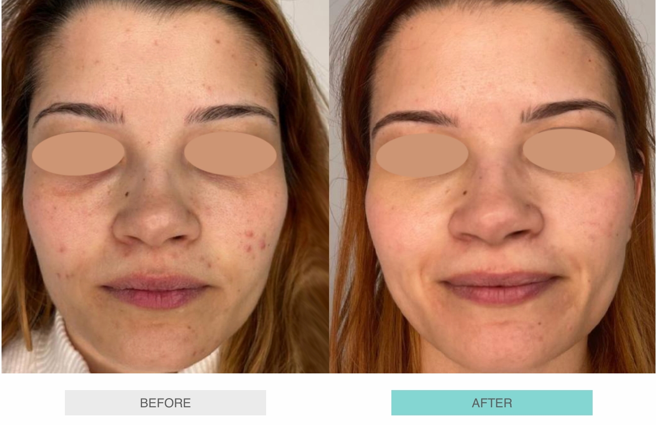 Exosomal Liquid Laser Facelift NYC (Before & After) - 2