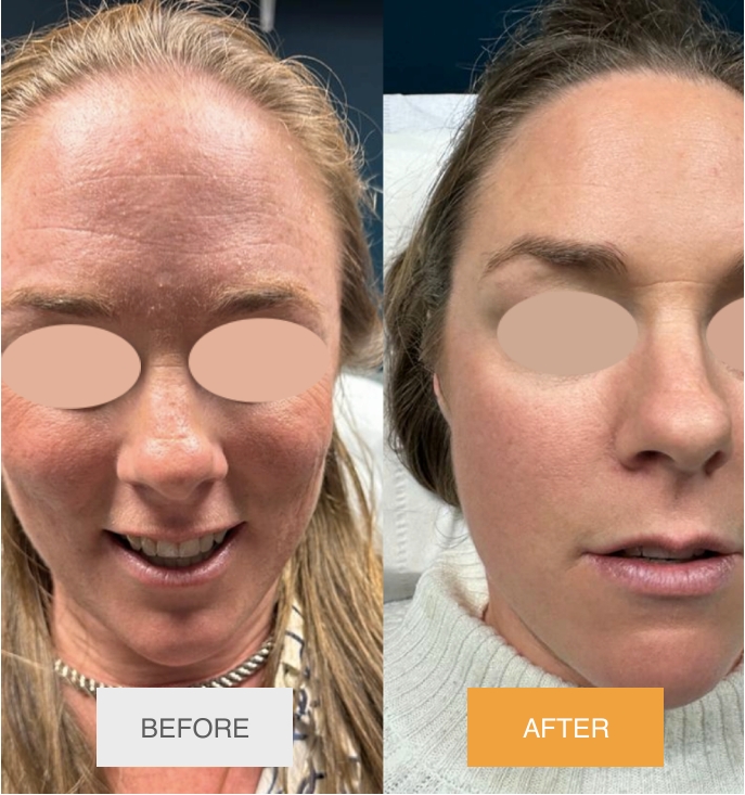 Exosomal Liquid Laser Facelift NYC (Before & After) - 4