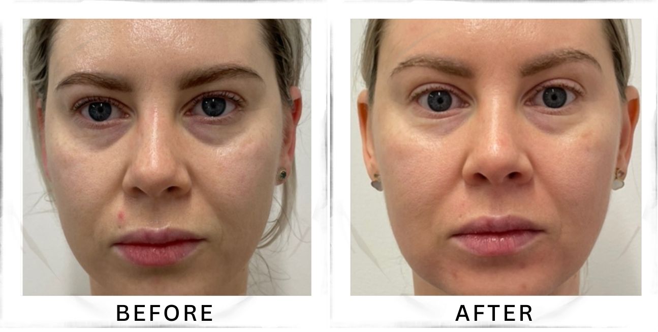 Exosomal Liquid Laser Facelift NYC (Before & After) - 5